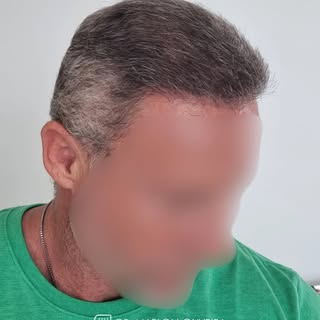Esse resultado mostra a importância de uma hairline bem planejada.

No transplante capilar, naturali