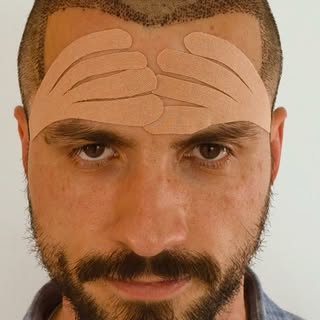 Eu não faço transplante capilar por medo da recuperação...

É uma das objeções que eu ouço no consul