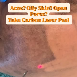 Carbon Peel is an advanced laser treatment designed to target active acne, excess oil, and enlarged 