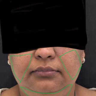 Non-Surgical Facelift with HIFU ✨

✔ Lifts sagging skin
✔ Sharpens jawline
✔ Stimulates natural coll