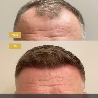 Naturalne zagęszczenie okolicy frontu w wykonaniu naszego katowickiego teamu 💉 

Dobra pierwsza lin