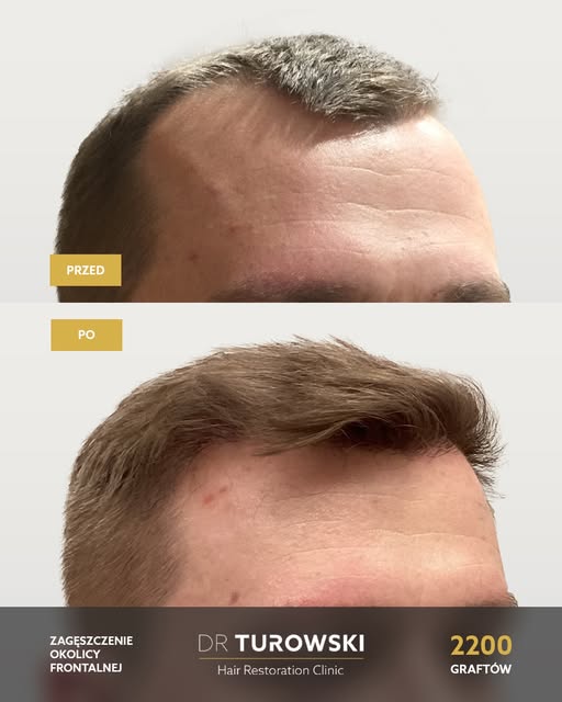 Naturalny rezultat obniżenia pierwszej linii. 💉

Włosy blond nie należą do najłatwiejszych w pracy,