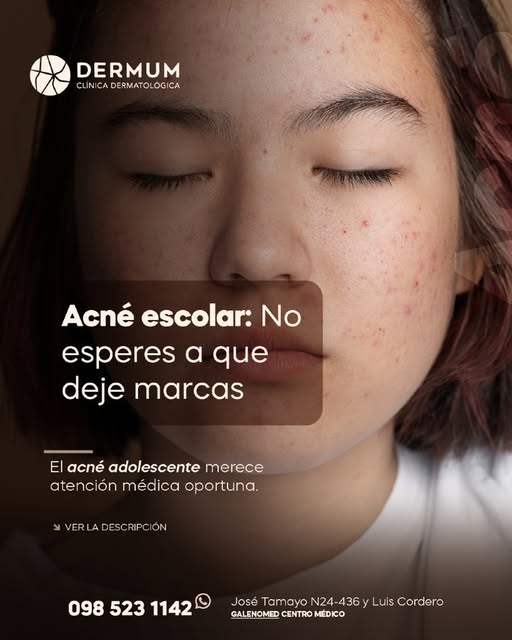 Durante la etapa escolar y adolescente, el acné suele verse como "algo pasajero", pero ignorarlo pue