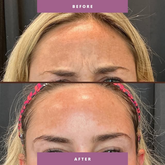 Prevention > correction. Neuromodulators in the upper face can prevent fine lines and wrinkles befor