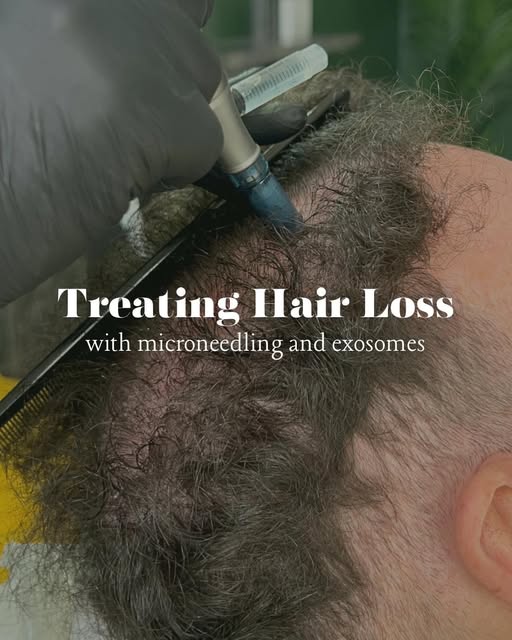 A personalised approach to hair restoration ✨

Microneedling and exosomes work together to support s