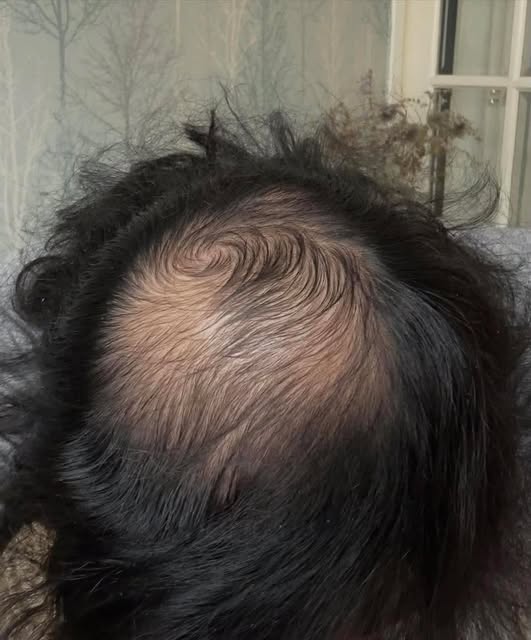 Real progress starts with the right plan 🙌

This client came to The Hair Farm with advanced male pa