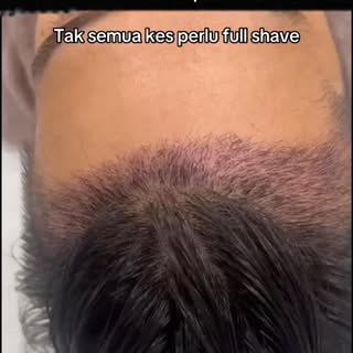 Tak semua kes perlu shave rambut untuk buat tanam rambut. Ada sesetengah kes, rambut di bahagian dep