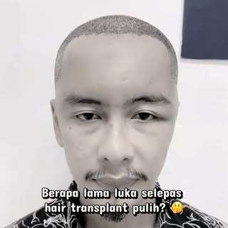 Ramai risau bila nampak muka bengkak selepas hair transplant (tanam rambut).

Sebenarnya, bengkak in