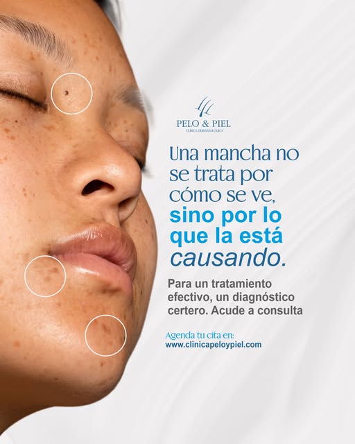 Una mancha puede parecerse a otra y, aun así, tener un origen completamente diferente.

Melasma, hi