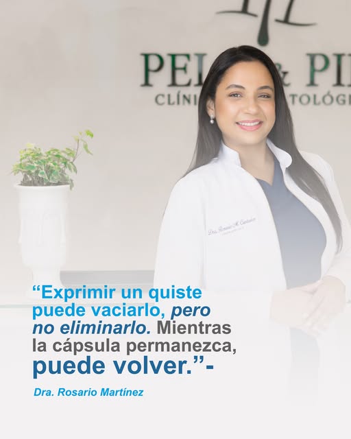 Exprimir un quiste puede dar la sensación de que el problema desapareció… pero muchas veces solo sal