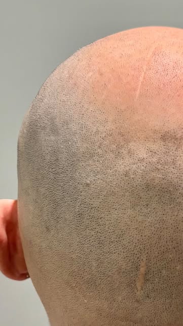 Achieving seamless scar concealment in just one session with expert SMP techniques. 

📍 Located in 