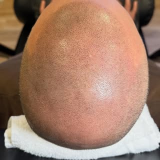 First session + a little hairline refinement ✨
Even subtle work can bring back a soft, natural-looki
