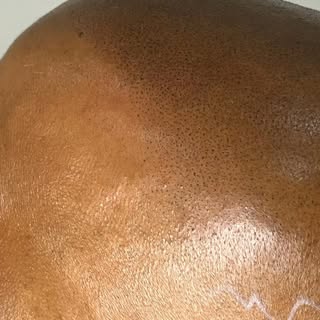 Hairline details! 

#smpvancouver #thinninghairsolution #hairlinetattoo #hairtattoo