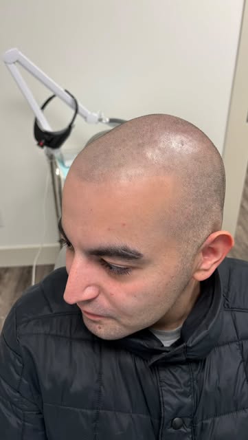 Real clients. Real results.

Natural-looking SMP designed for your hairline, your hair loss and the 