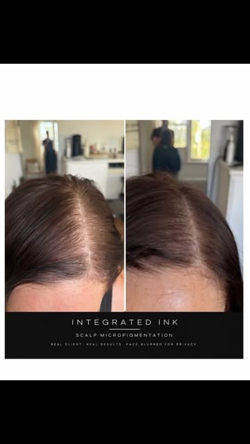 A little density treatment for this lovely client who has been dealing with androgenetic alopecia an