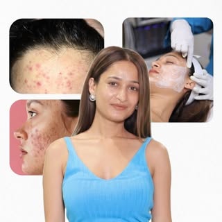 Acne, whiteheads, blackheads, recurring pimples, pigmentation or uneven skin texture?

In this video