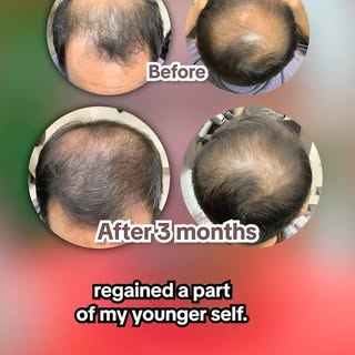 Unlock your confidence like Uncle Cedric did!🙂‍↔️
Discover TrichoLab’s Microneedling 😎✨

#TrichoLa