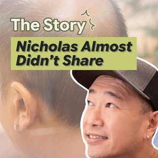 Hair loss rarely happens suddenly. For Nicholas, it began in his late 20s, the average age male patt