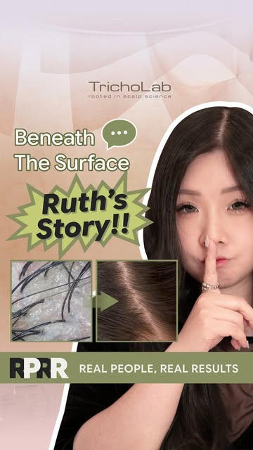 For years, Ruth felt self-conscious about her scalp.

Friends would comment on it, and over time, sh