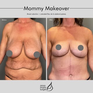 #aMAYSingTransformation 🔥 | Breast reduction and extended fleur de lis tummy tuck by Board-Certifie
