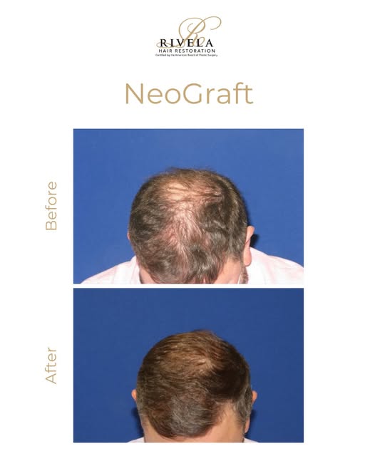 This before-and-after highlights what may be possible with NeoGraft, a minimally invasive FUE (Folli