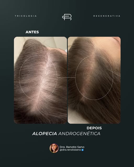 “Dra., meu cabelo está cada vez mais fino e meu couro cabeludo está aparecendo.”

Essa é uma queixa 