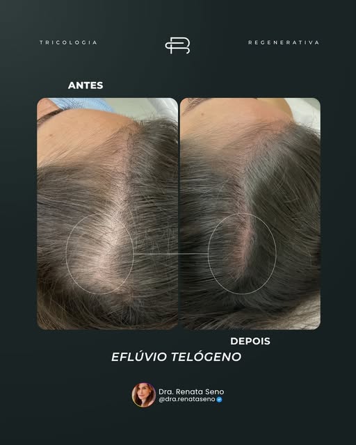 Você já teve uma queda de cabelo repentina, sem explicação aparente, e ficou assustada achando que n