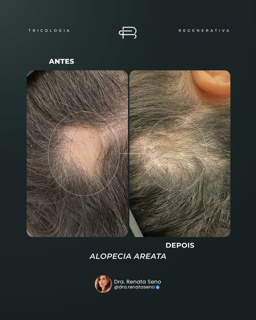 Esse paciente chegou até nós com alopecia areata e uma falha bem evidente, onde já não era possível 