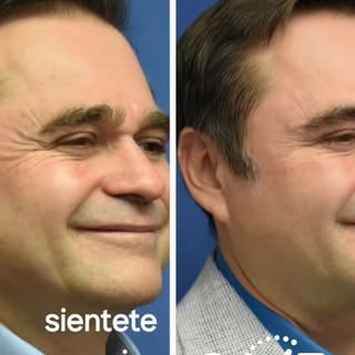 No es cambiar tu cara… es verte más joven y descansado 😌
💉 Bótox con resultados naturales (sin efe
