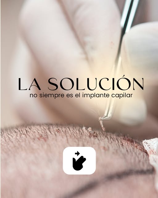 ¿Preocupado por la caída del cabello? 🤔 La solución no siempre es el implante. En Rondil Hair Centr