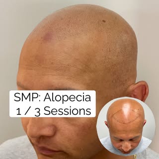 One session can make a powerful difference.

This SMP transformation was created for alopecia-relate