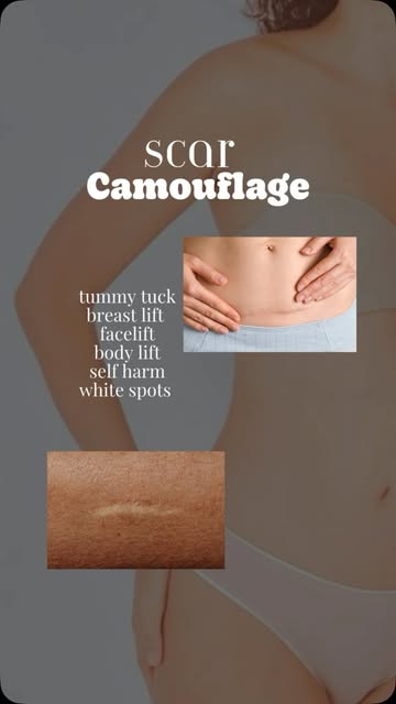 Looking for scar camouflage or stretch mark camouflage with natural-looking results?

Dermagrafix sp