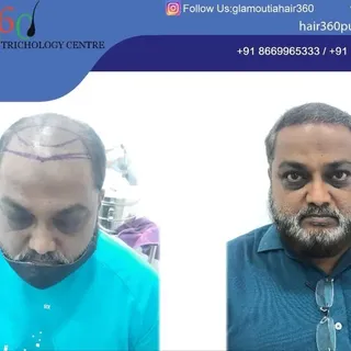 For The Best Results, Hair360 Trichology Center,Kharadi,Pune 
#hair #hairtransplants #hairgrowth #ha