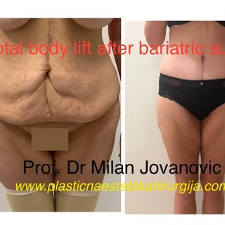 Total body lift 360 degrees after bariatric surgery by Prof. Dr Milan Jovanovic