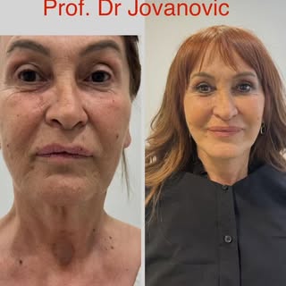 Deep plane face lifting by Prof. Dr. Milan Jovanović, before and after