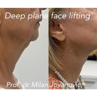 Deep plane face lifting by Prof. dr Milan Jovanovic