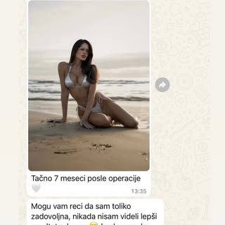Augmentacija dojki, Jedna od mnogobrojnih zadovoljnih pacijentkinja Prof. Dr Jovanovica sa povećanje