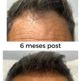 ✨✨ Resultats 6 mesos després del trasplantament de cabell ✨✨

Estem molt orgullosos de compartir els