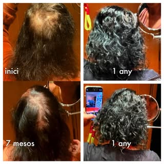 📸 Resultats Reals amb Dutasteride 📸

Tenim el plaer de compartir l’experiència d’una pacient que h