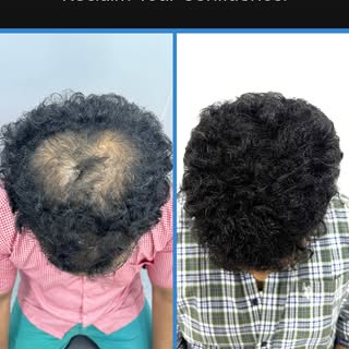 Confidence starts where the hairline begins. Watch the comeback story!
Watch this amazing hairline t