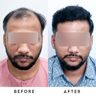 Stop scrolling and start growing! 🌱 Why settle for a receding hairline when you can have a permanen