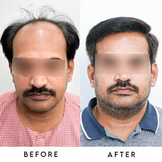 Confidence Restored. ✅

From thinning to thriving. Swipe left to view the complete coverage and natu