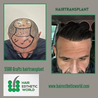 Na een haartransplantatie krijgt u uw zelfvertrouwen terug en kunt u volop genieten van uw volle haa