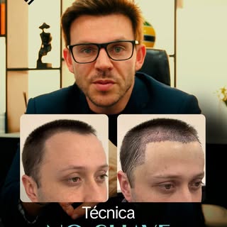 O No Shave pode ser uma escolha estética pela discrição no pós operatório, mas pode ser também uma i