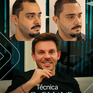 Quando o caso é bem indicado e o planejamento é preciso, o transplante no shave  entrega naturalidad