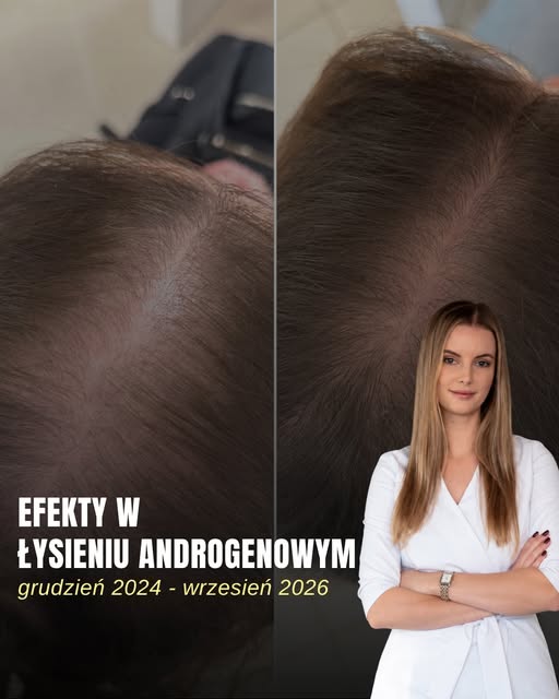 Łysienie androgenowe - efekty, na które warto było czekać. 🔥

Moja pacjentka rozpoczęła swoją terap