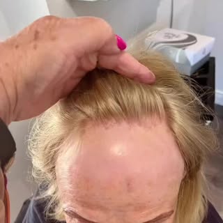 My client is experiencing frontal fibrossing alopecia which is causing her great distress. Here’s a 