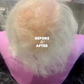 #hairloss  #irishcancersociety  #oncologynurse  #wigs  #alopecia  #alopeciaareata  #thinninghair  #h