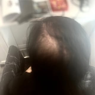 My lovely young client came in today feeling really distressed about her partial alopecia. She’s bee
