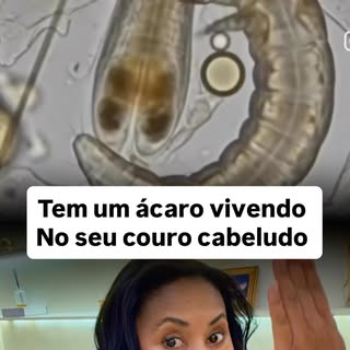 Tem um pequeno ácaro vivendo no seu couro cabeludo e você provavelmente nem imagina. 👀

O Demodex f